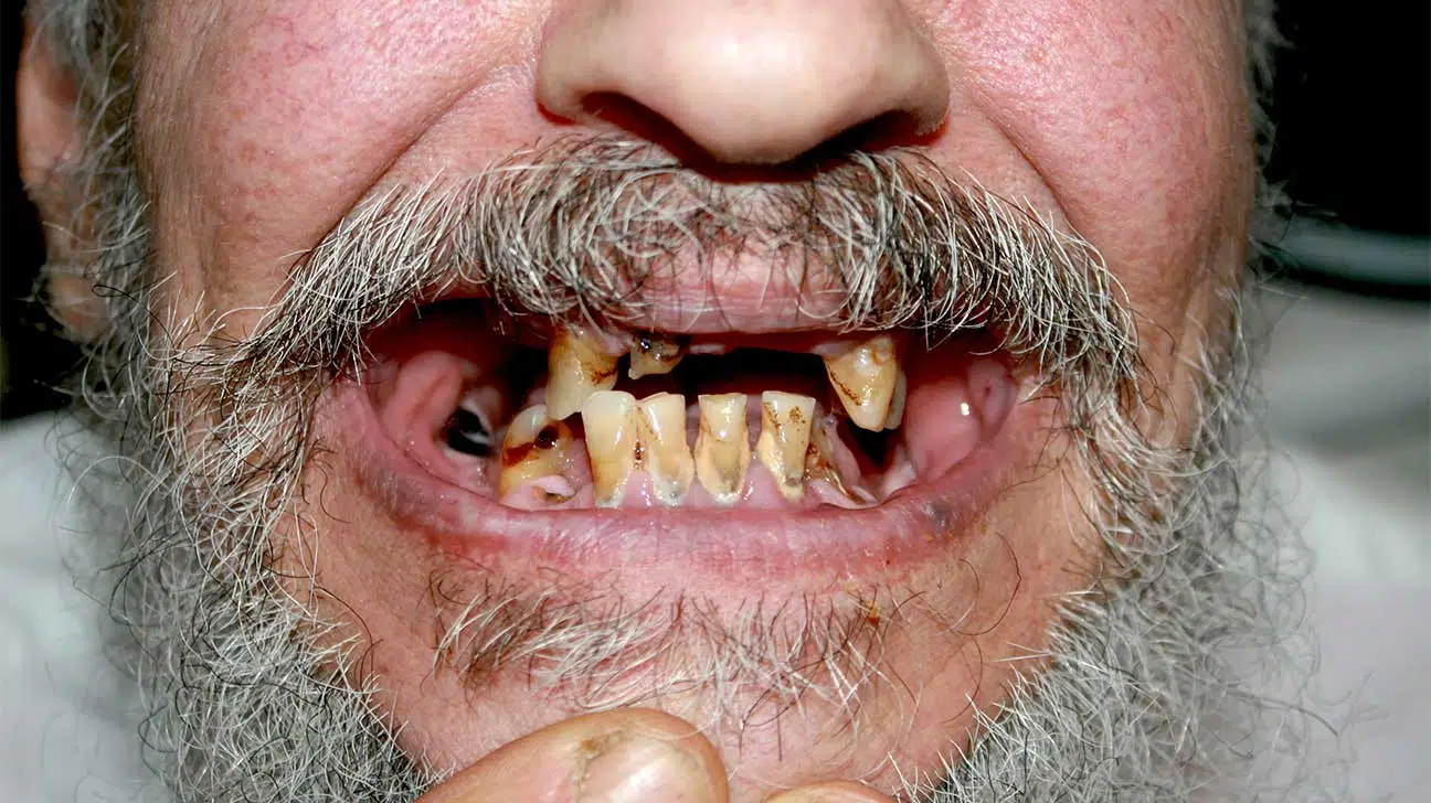 Crack Tooth Decay: How Crack Affects Oral Health
