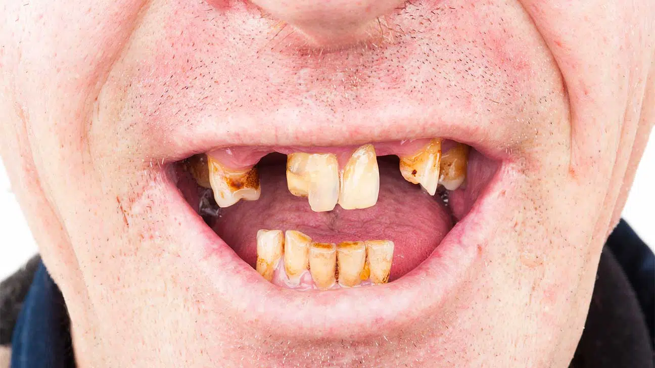 What Do Heroin Teeth Look Like?