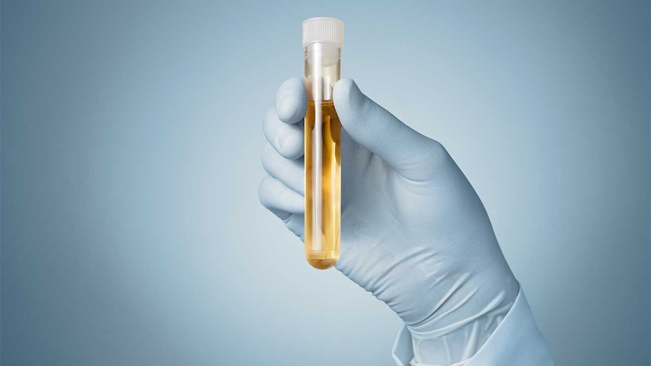 How Long Is Heroin Detectable In A Urine Test?